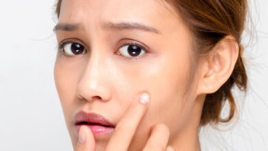 Can Mederma Be Used To Deal with Pimples Scars?