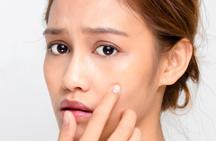 Can Mederma Be Used To Deal with Pimples Scars?