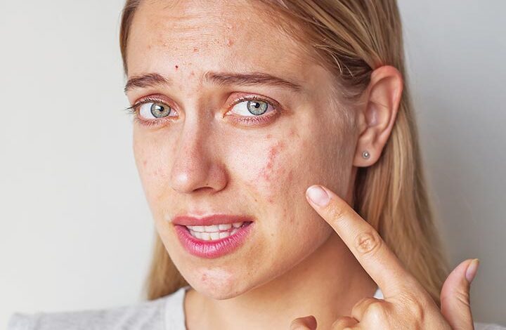 12 House Cures To Lighten Zits Scars