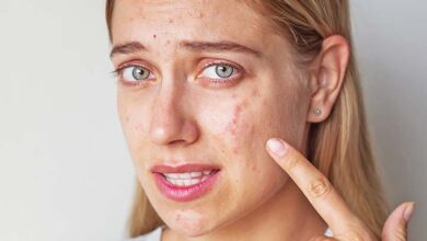 5 Best Dwelling Therapies For Cystic Pimples