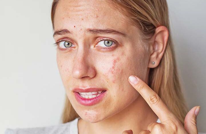 5 Best Dwelling Therapies For Cystic Pimples