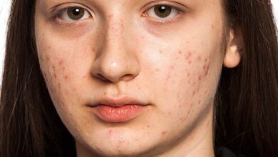 11 Greatest Dwelling Cures To Get Rid Of Facial Scars Naturally