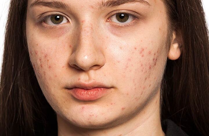 11 Greatest Dwelling Cures To Get Rid Of Facial Scars Naturally