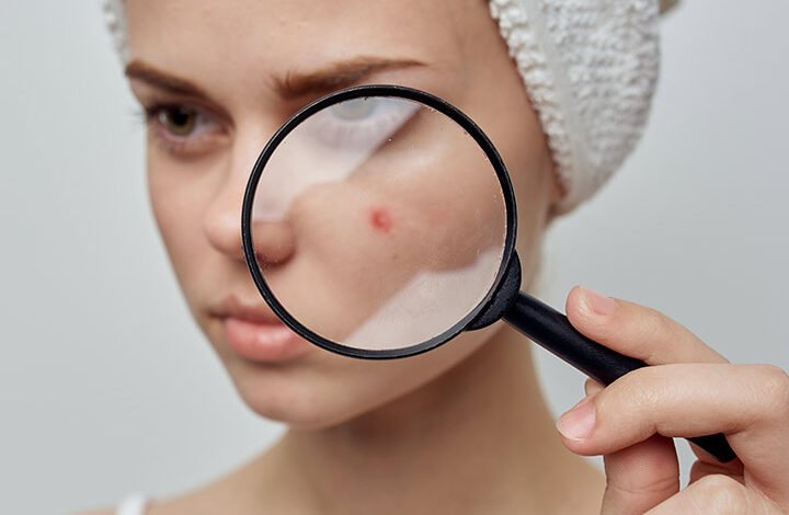 Vitamin E For Pimples: Is It Environment friendly?