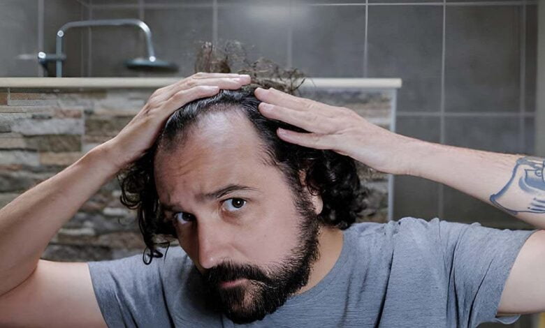 Hair transplant: an effective solution against baldness?