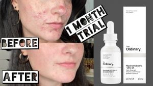 Can Niacinamide Set off Zits