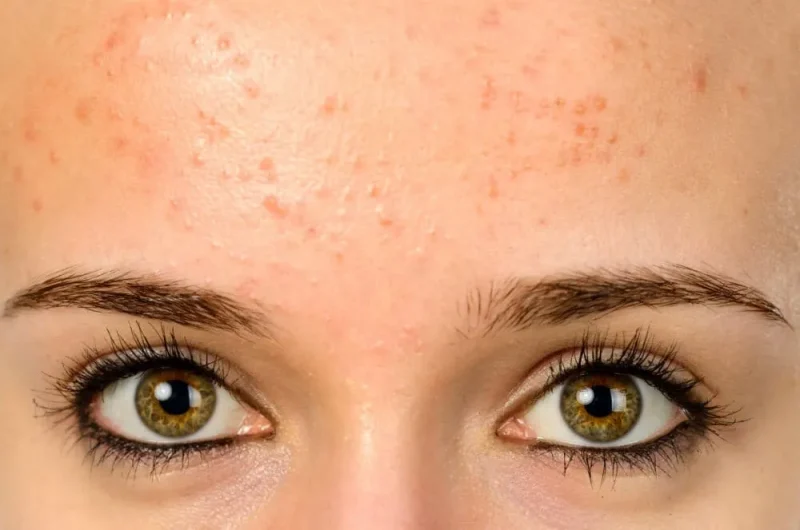 Understanding Fungal Acne. What is Fungal Acne?