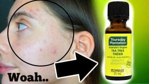 Tree Tea oil for Once more Pimples