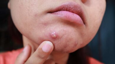 Cystic Acne: Natural Treatments and Everything You Need to Know