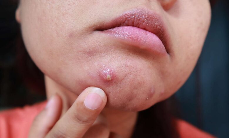 Cystic Acne: Natural Treatments and Everything You Need to Know