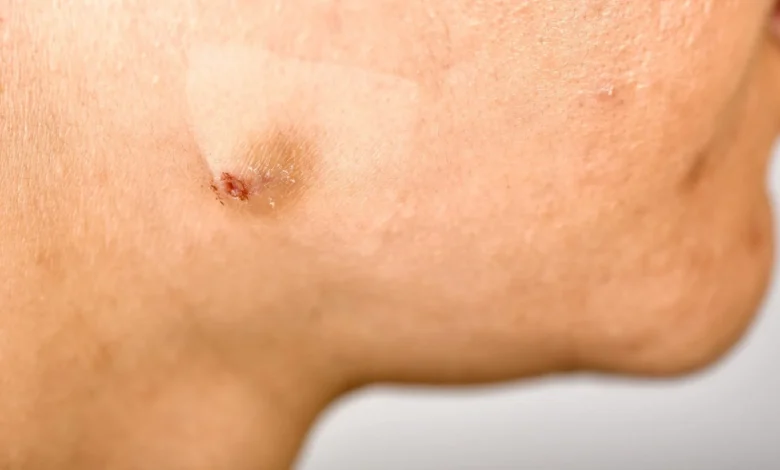 What Not to Do If You Have a Deep Pimple
