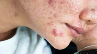 What Not to Do If You Have a Deep Pimple