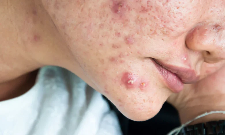 What Not to Do If You Have a Deep Pimple